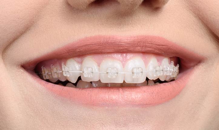Read more about the article Ceramic White Braces to Invisalign – Expert Insights