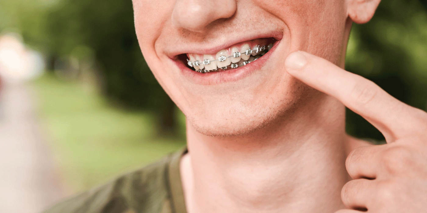 Students-Braces-in-Dubai