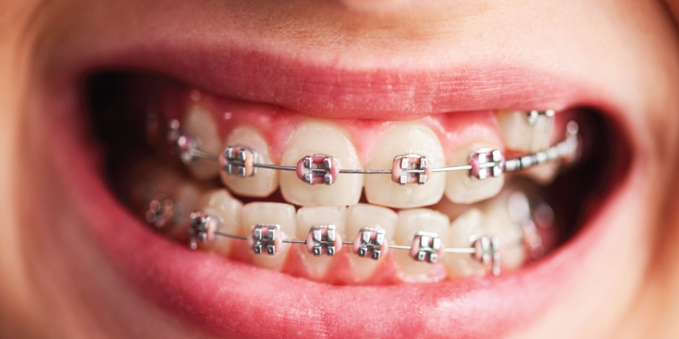 Braces-or-Invisalign-in-Dubai