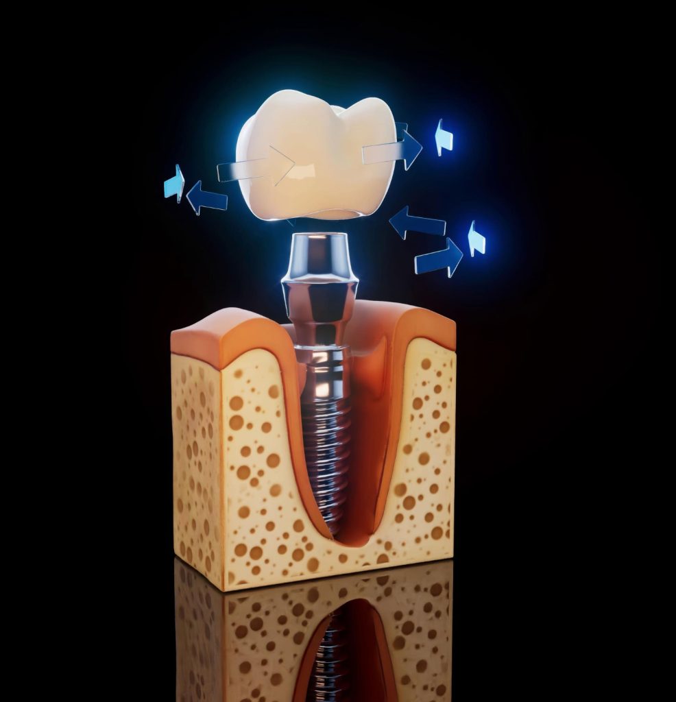 Dental Impant Solution Dubai