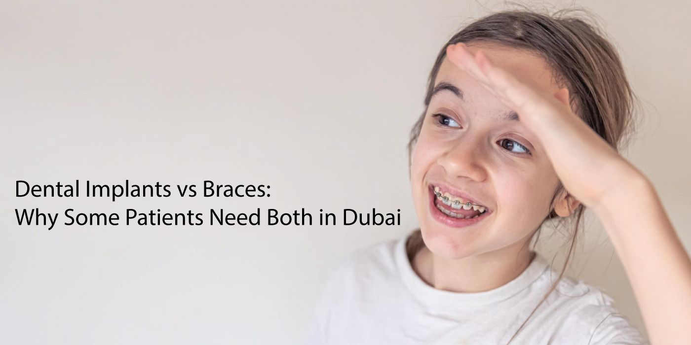 Dental-Implants-Vs-Braces-Dubai