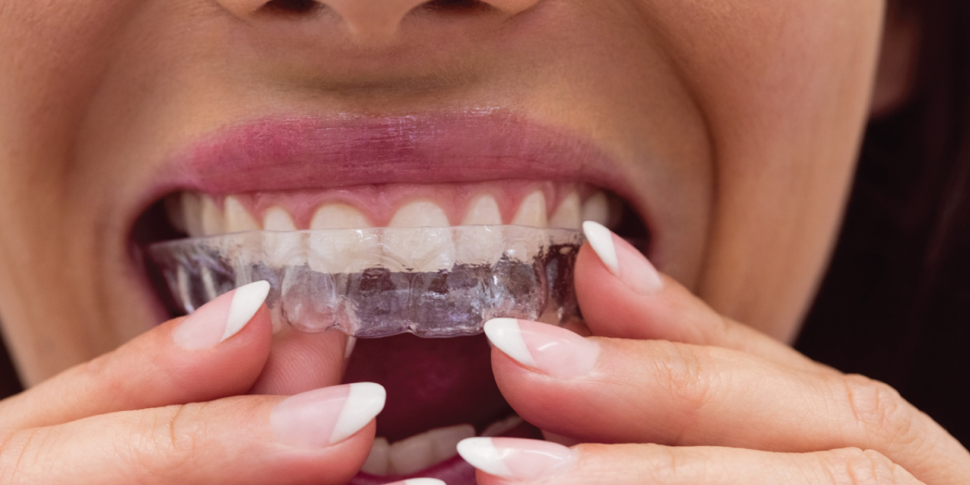 Invisalign-Aligners-Dubai