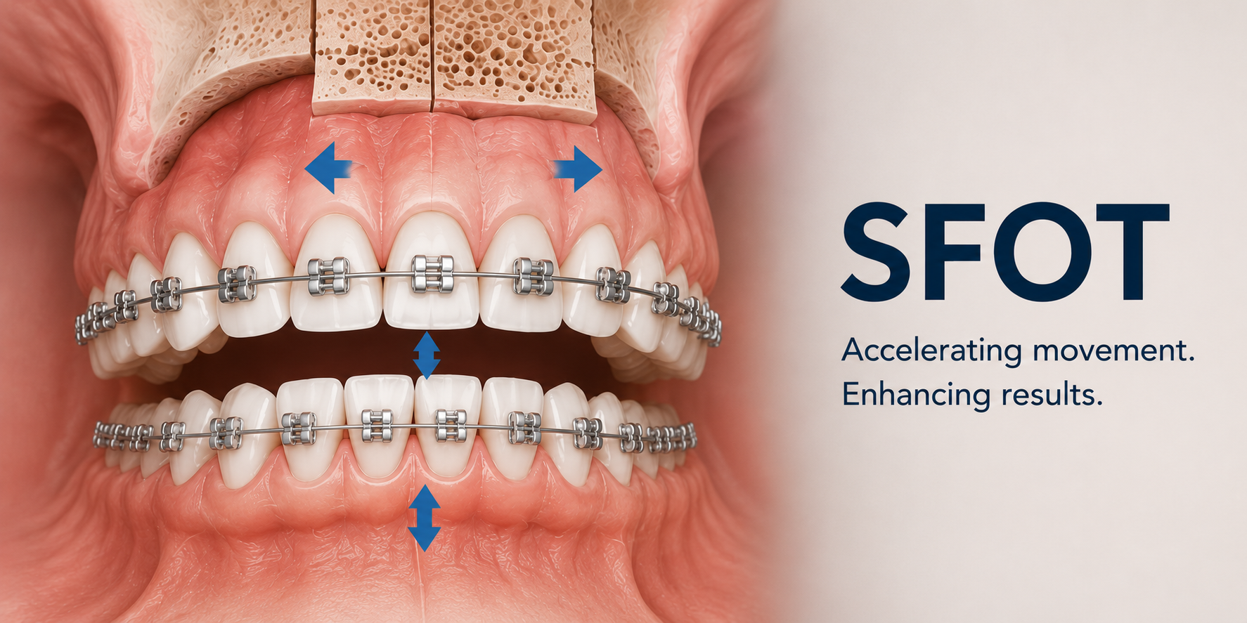 SFOT in Dubai-Surgically Facilitated Orthodontic Therapy