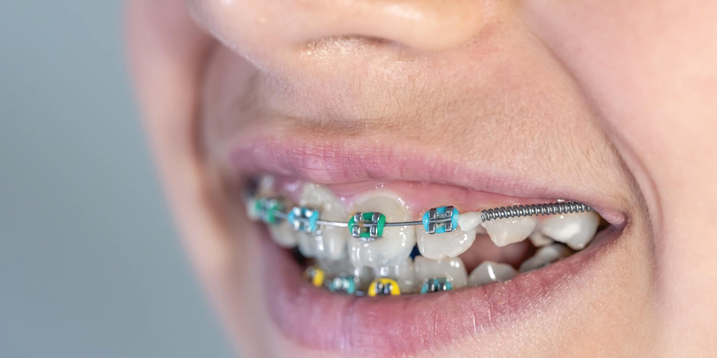 Best-braces-colors-in-Dubai