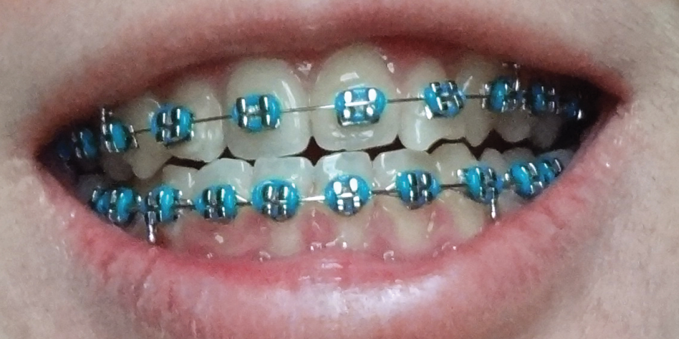Braces-in-Dubai