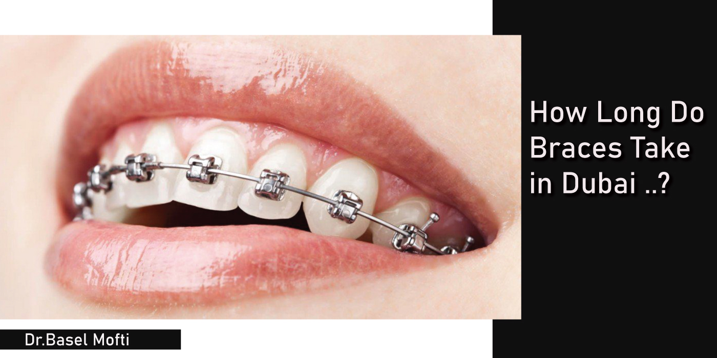 How-long-Do-Braces-Take