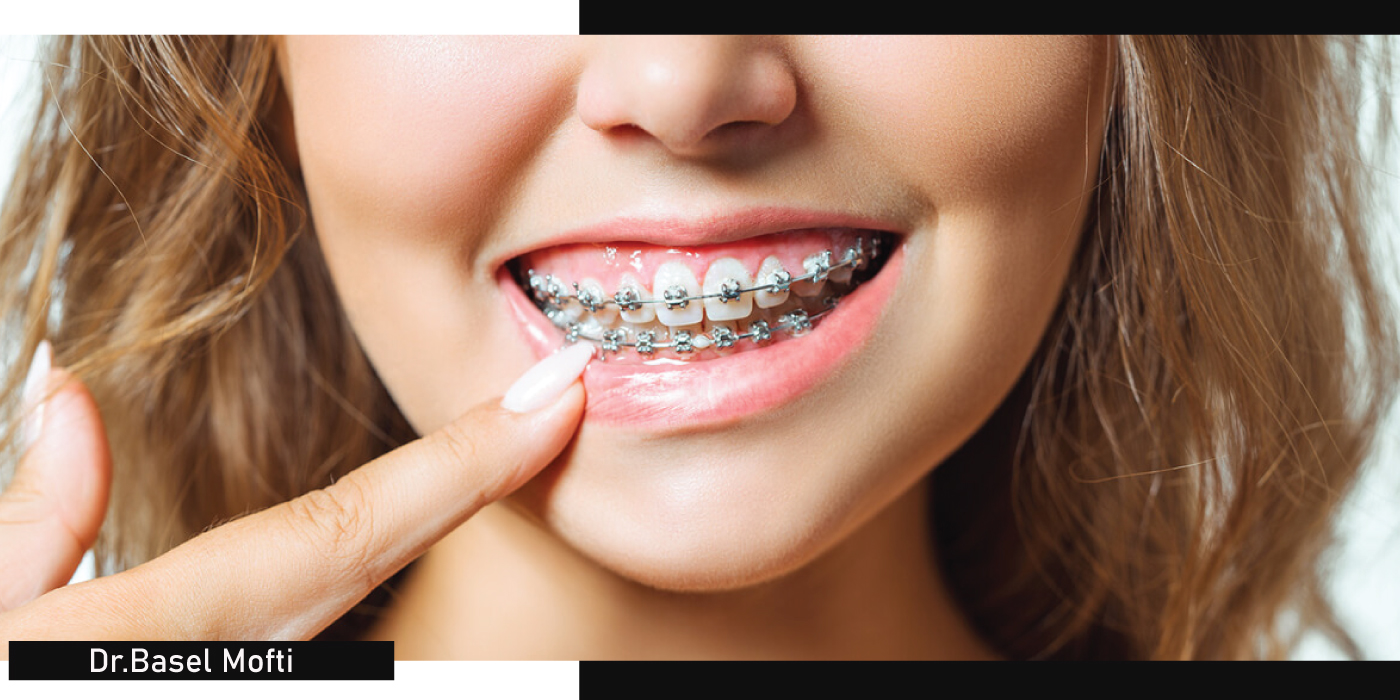 Oral-Braces-Process-in-Dubai