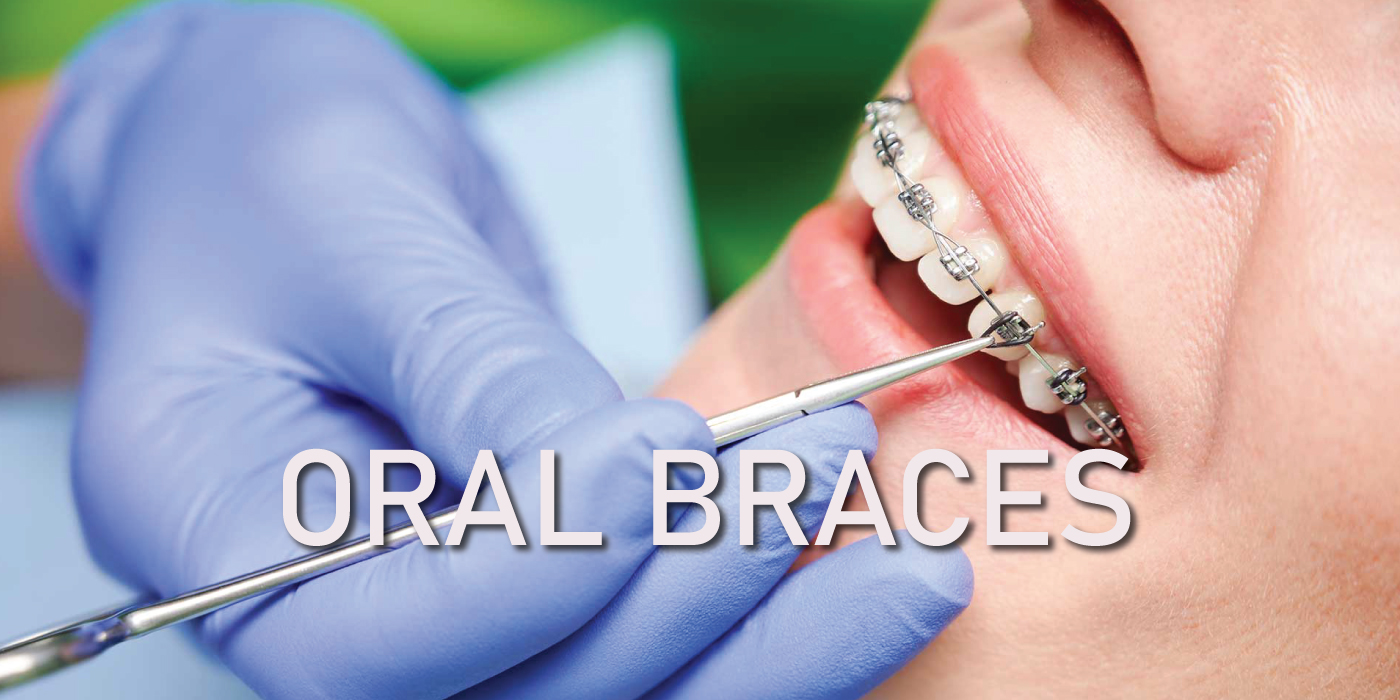 Oral-Braces-in-Dubai