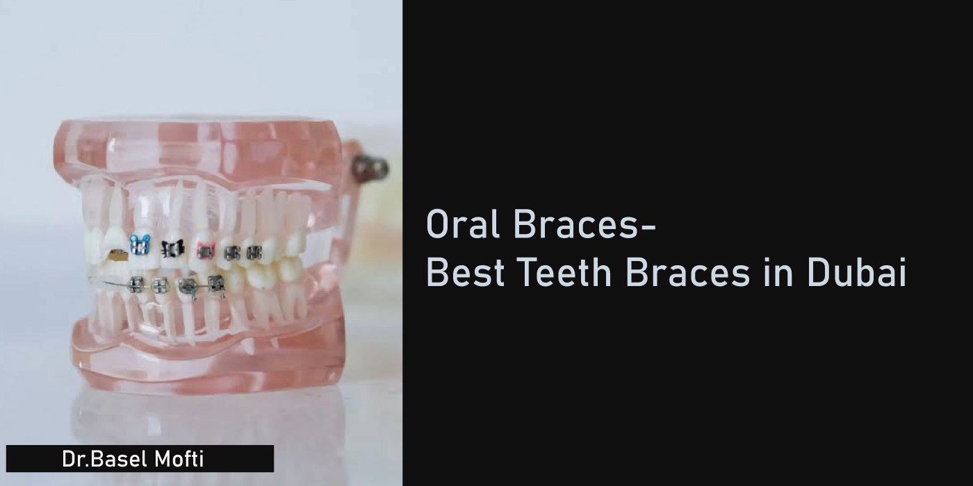 Teeth-Braces-Process-in-Dubai