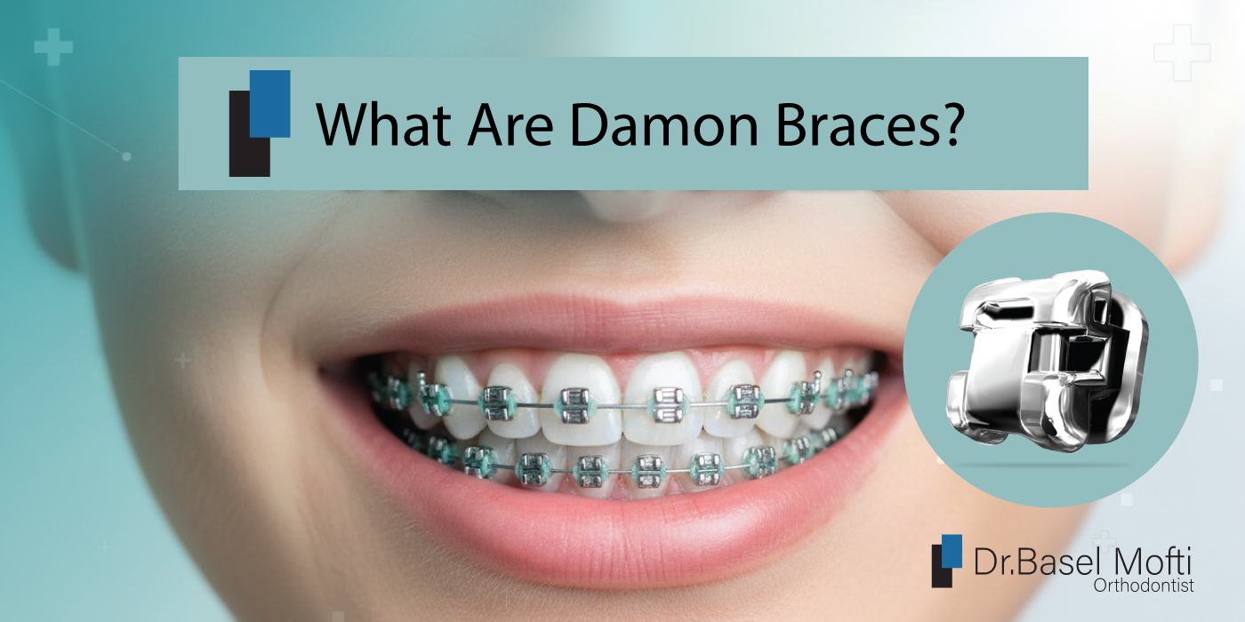 What-Are-Damon-Braces